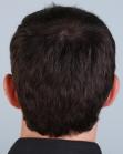 After Hair Transplant&nbsp;Front